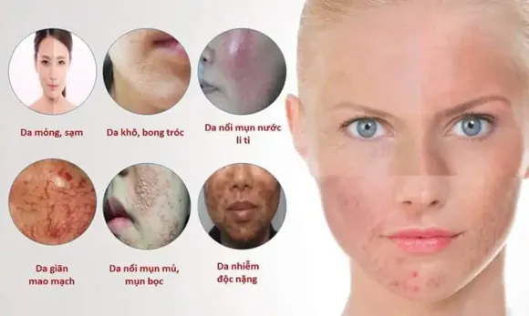 Điều trị Nám - Sạm da