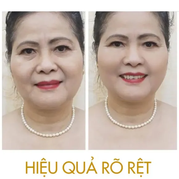 Điều trị Nám - Sạm da
