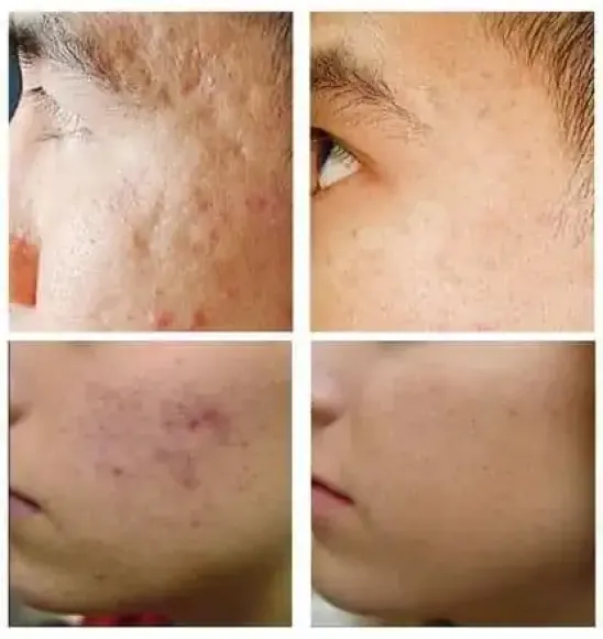 Điều trị Nám - Sạm da
